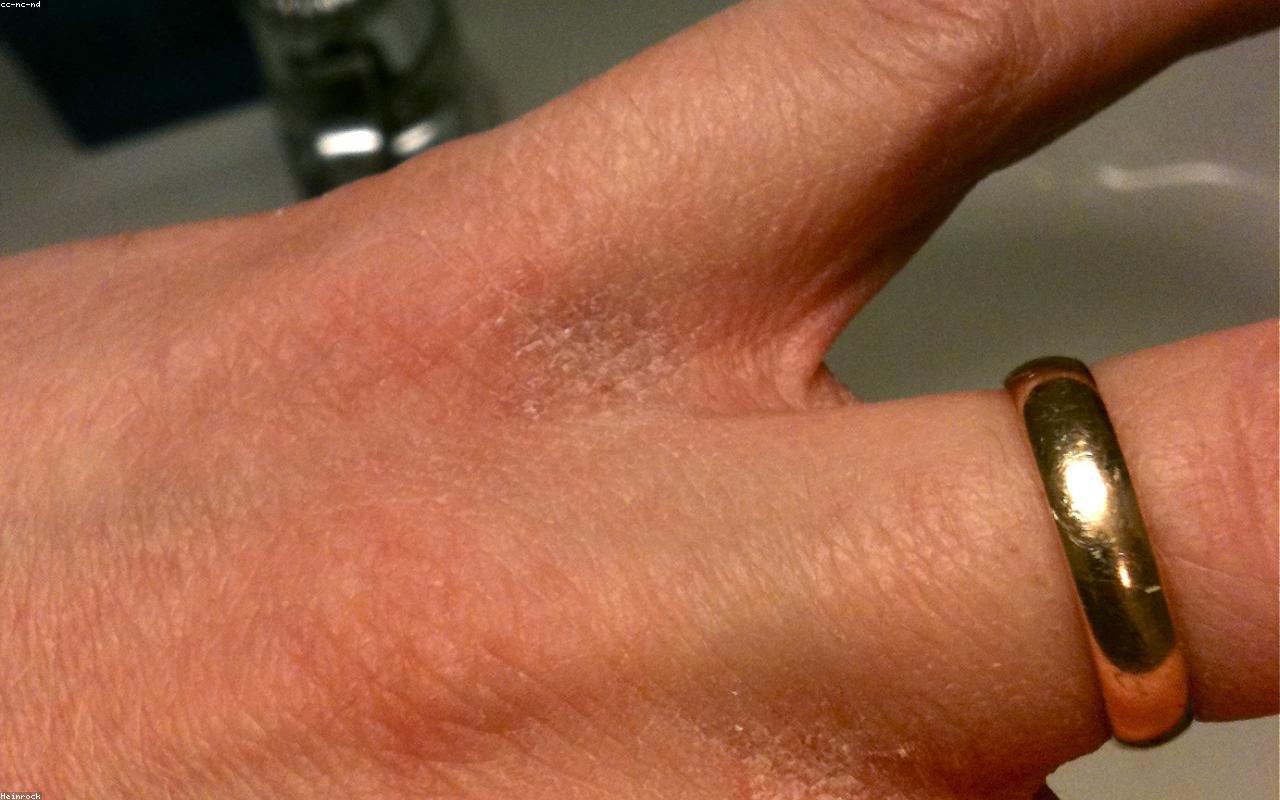 입술 갈라짐 원인 7가지, 봄철에 더 심하고 자주 틀 때 이미지 3